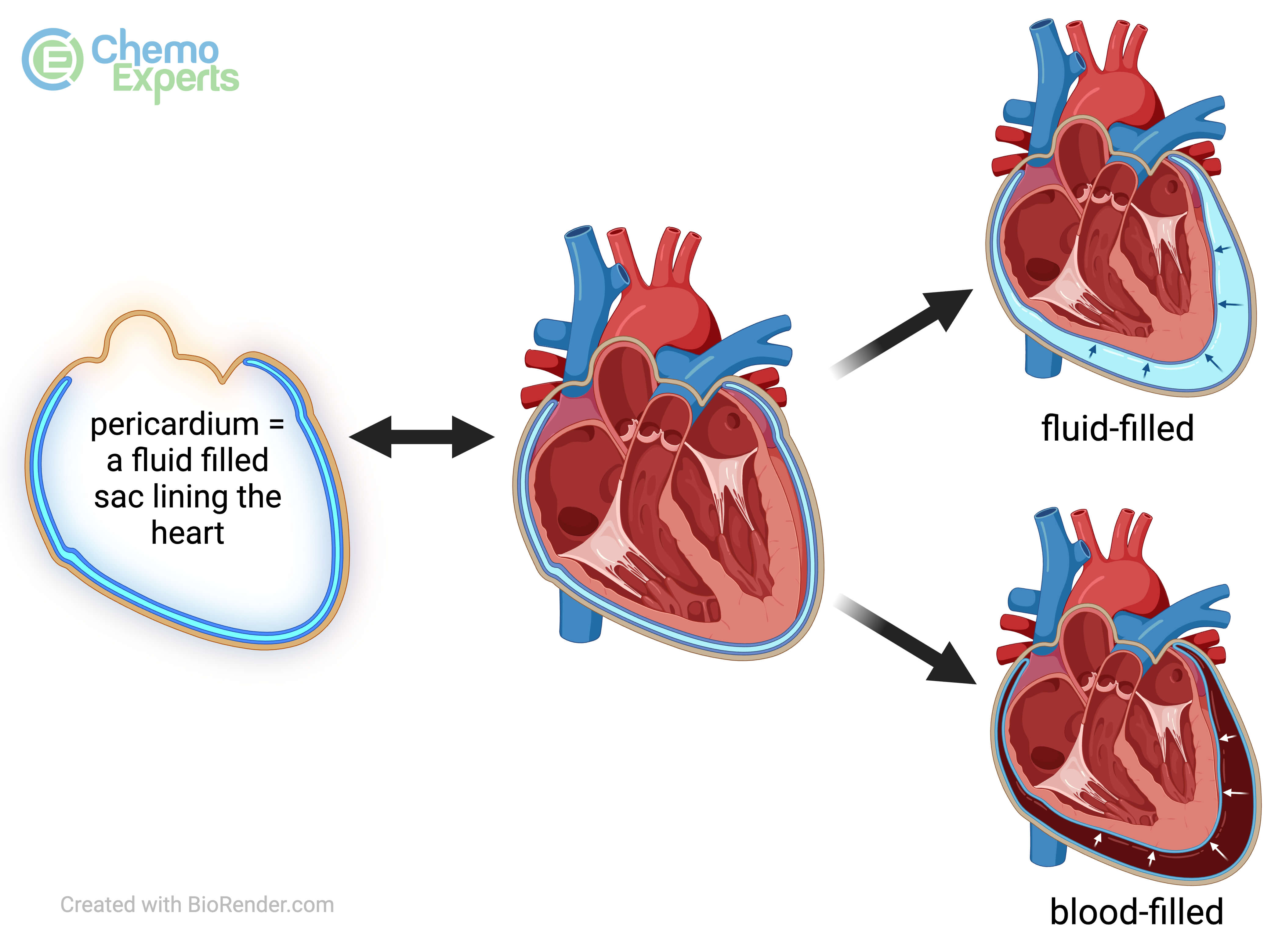 Pericardial effusion